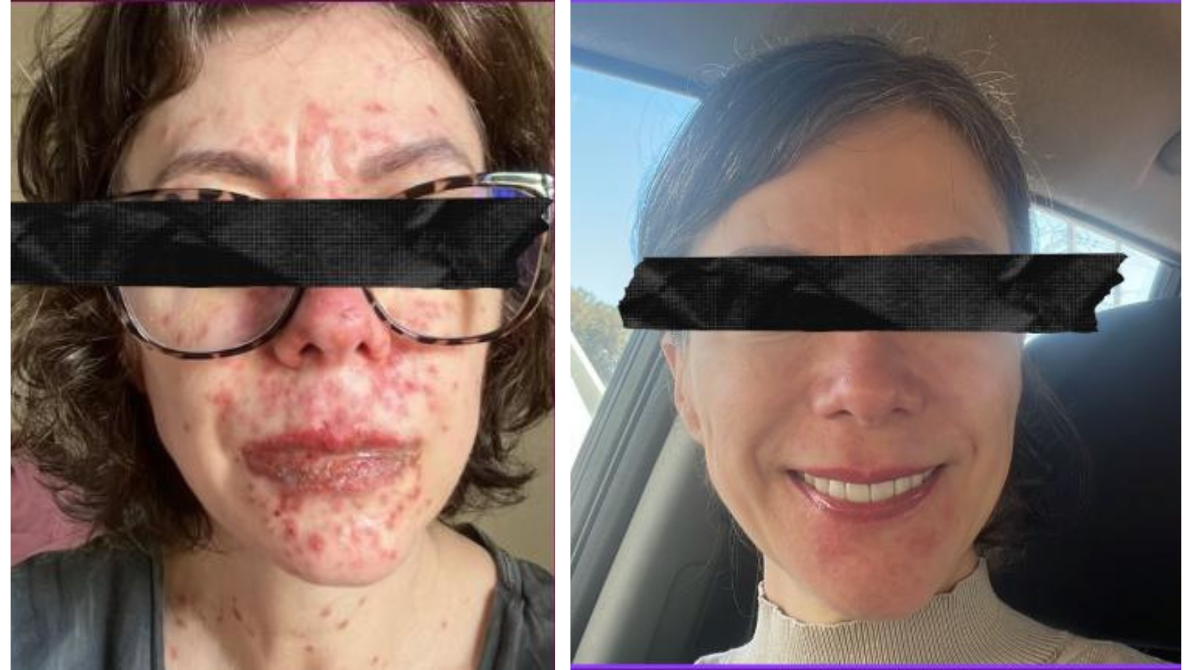 Antes e depois de tratamento com laser
