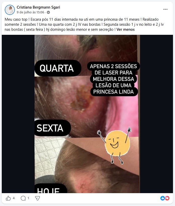 Resultado de tratamento com laser